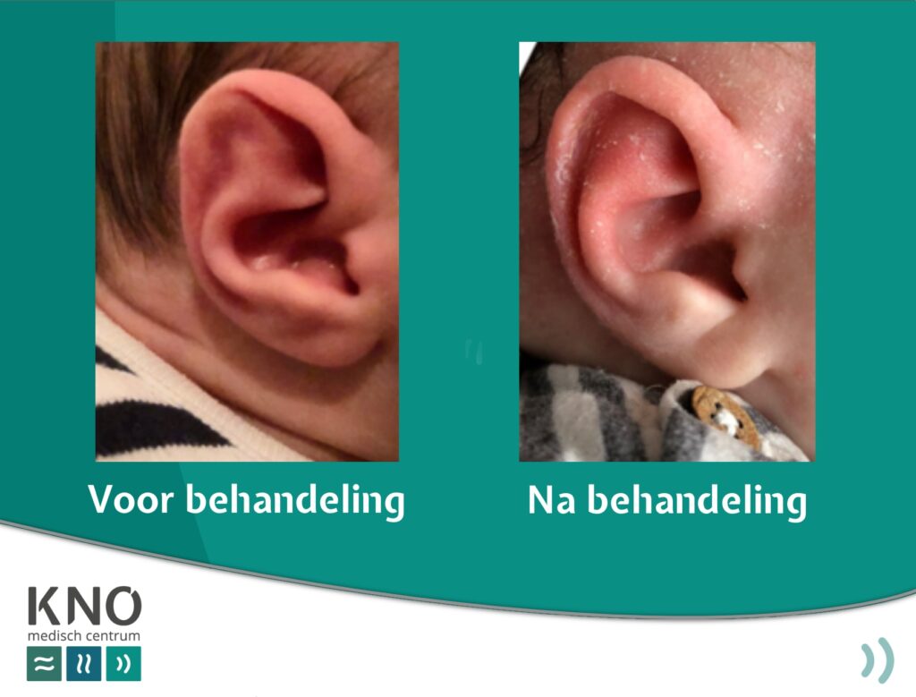 spalken van de oorschelp bij een baby