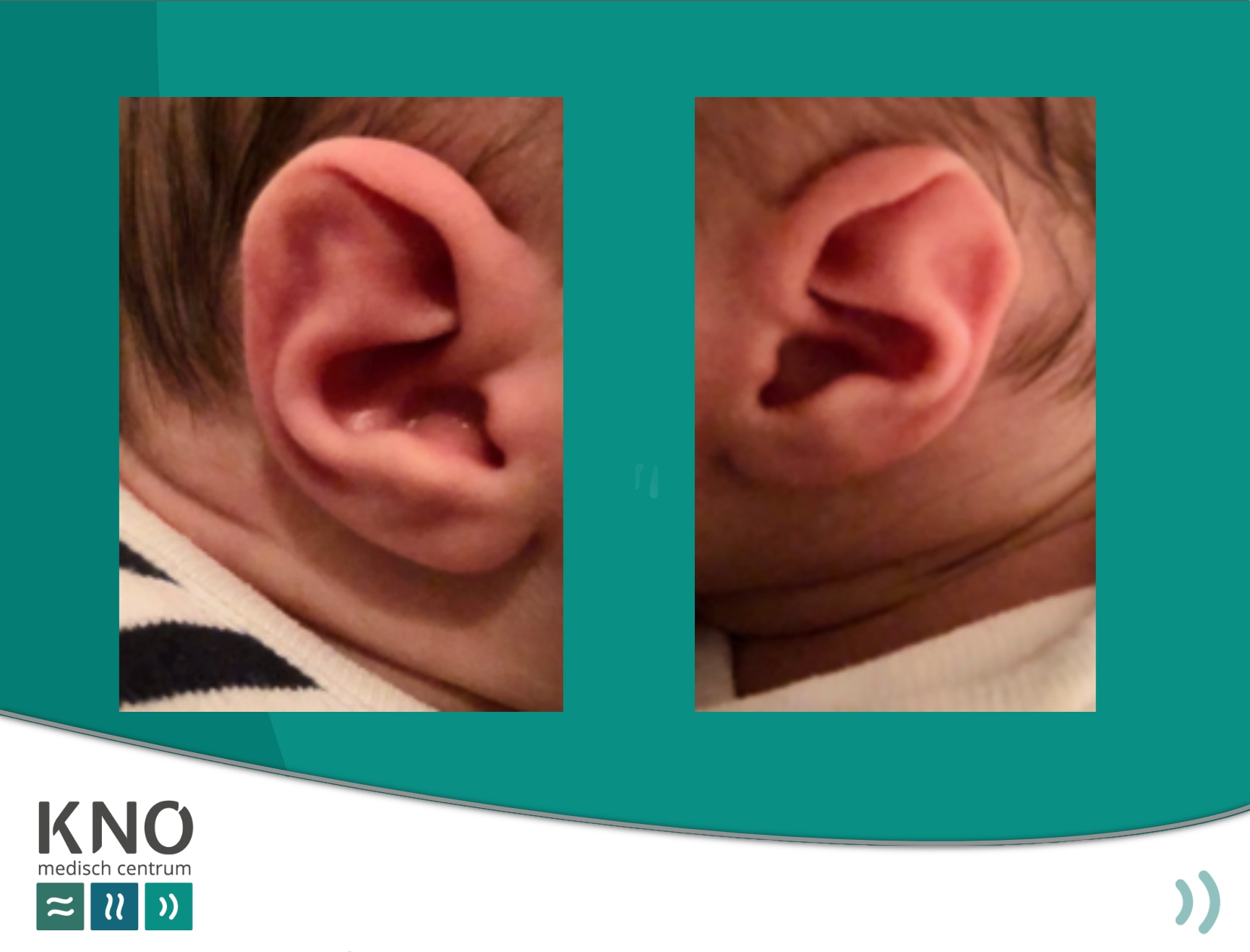 oorschelpafwijkingen bij een pasgeboren baby